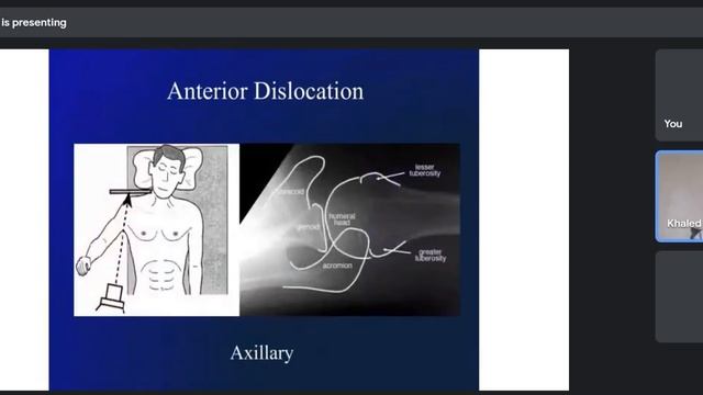 Shoulder Dislocation | Dr. Khaled Aneiba смотреть онлайн