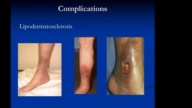 Advancing Patient Care with Radiology - Varicose Veins - More Than Just A Cosmetic Problem смотреть онлайн