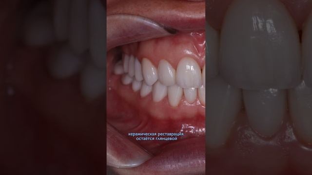Композитные виниры. Мнение профессионала смотреть онлайн