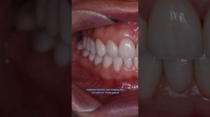 Композитные виниры. Мнение профессионала