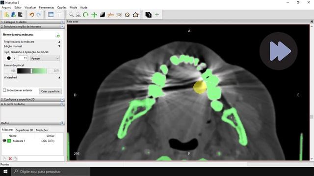 InVesalius - Tutorial 3 - Segmentação Manual смотреть онлайн