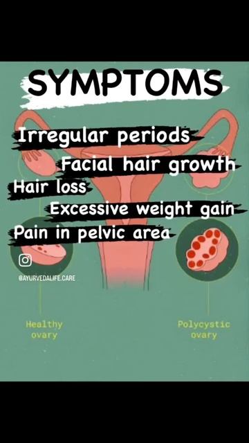 PCOS SYMPTOMS #ayurvedaforhealth #irregularperiod #leucorrhea #panchkarmaayurvedaclinic #pcos