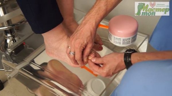 Изготовление индивидуального силиконового корректора