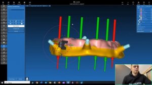 Обучение хирургическим шаблонам в программе RealGuide. Разборные шаблоны.