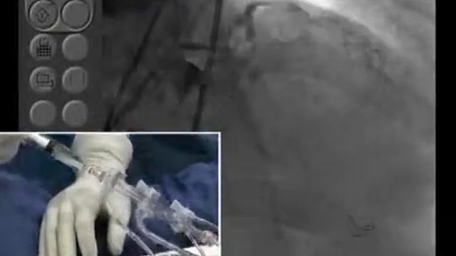 Rotational Atherectomy and DES - October 20, 2009 Webcast Video смотреть онлайн