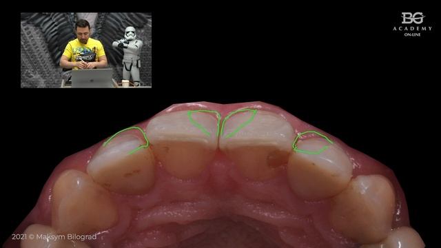 Cut my teeth off | BG Dental Cases #32 смотреть онлайн