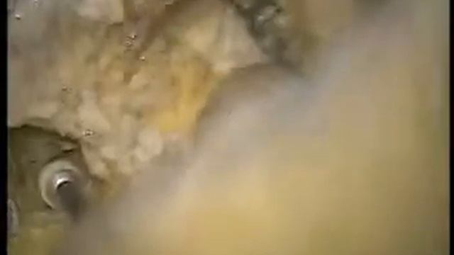 part 14 Trans canal facial nerve exposure смотреть онлайн