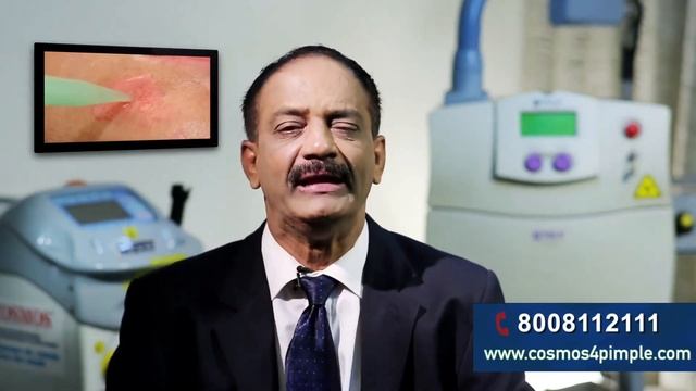 How To Remove Tattoos Telugu | Tattoos Removal Treatment | Cosmos 4 Pimple смотреть онлайн