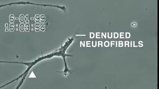 How Mercury Destroys Neurological Tissue