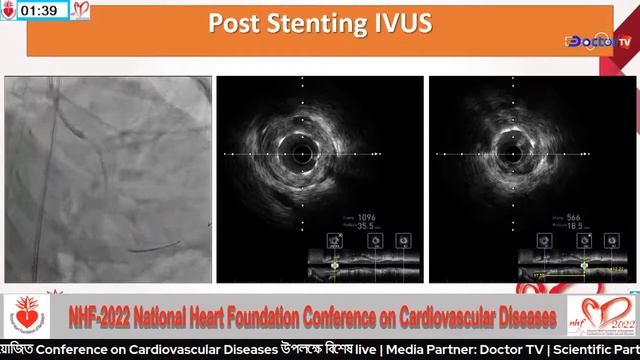 Conference on Cardiovascular Diseases смотреть онлайн