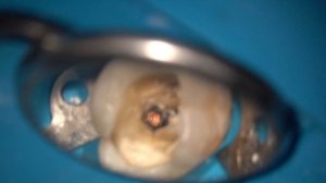 Пломбирование корневых каналов моляра (обтурация 1,6 зуба) методом непрерывной волны