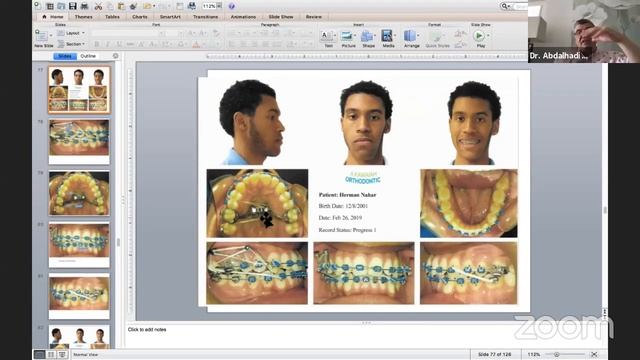 MARPE for Asymmetrical Faces & Apnea смотреть онлайн
