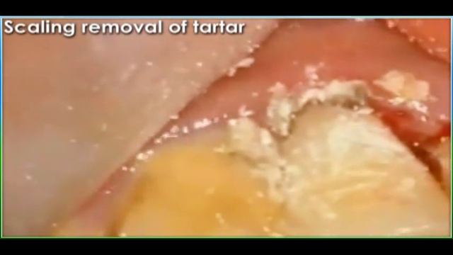 Scaling, Removal Of The Tartar