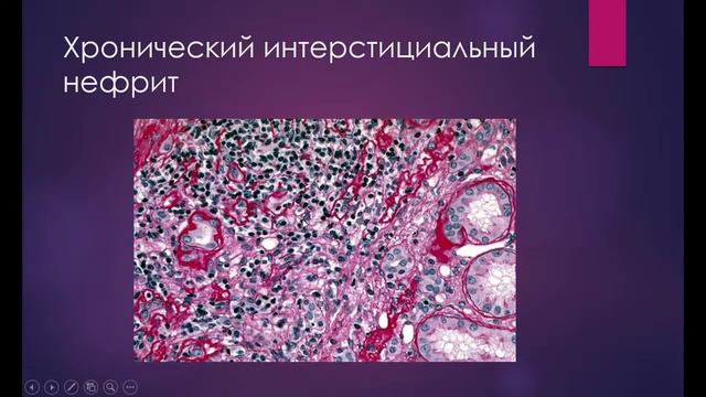 Лекция 4: Патологическая анатомия болезней почек. 25.02. - 8.30 смотреть онлайн