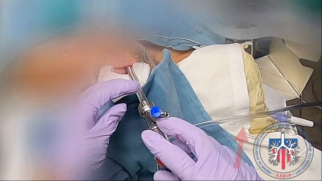 Rigid Bronchoscopy: Manual Jet Ventilation смотреть онлайн