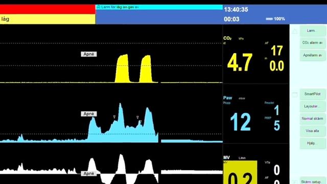 Endotracheal Intubation смотреть онлайн