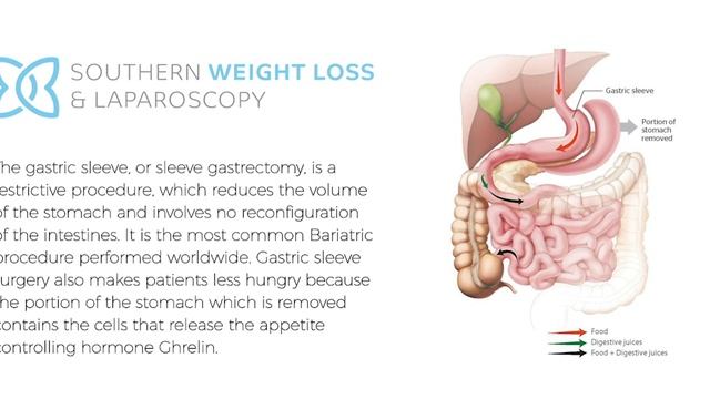 Gastric Sleeve, Southern Weight Loss & Laparoscopy, Suite 6, Marinoto Clinic, 72 Newington Avenue, смотреть онлайн