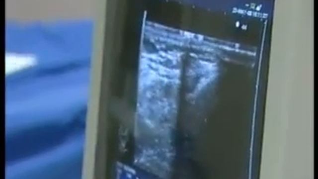 varis tedavisi canlı Lazerle varis tedavisi смотреть онлайн