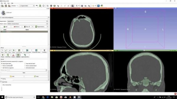 Slicer3d vs. Invesalius