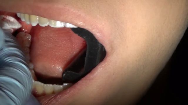 wisdom tooth extraction 32 or 42 (part 1) смотреть онлайн