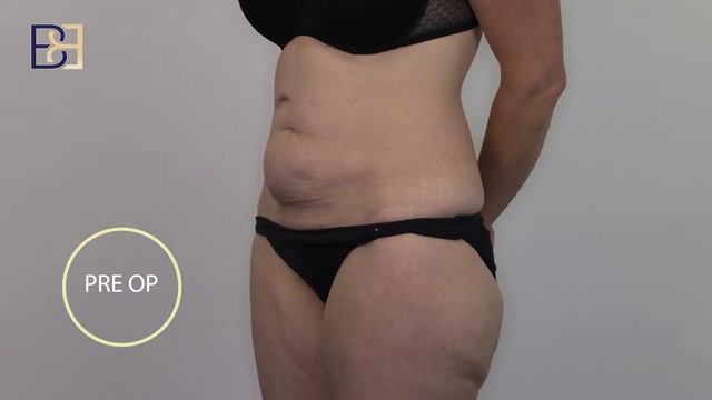 Abdominoplasty after loosing 66 kg of weight [Before & After] {video result} смотреть онлайн