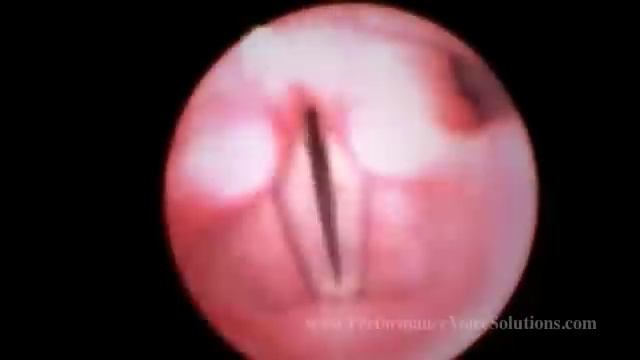 Video Stroboscopy Of Vocal Cords