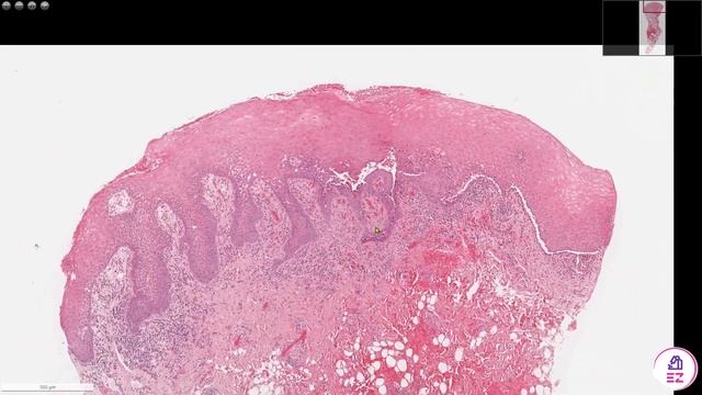 Pemphigus vulgaris смотреть онлайн