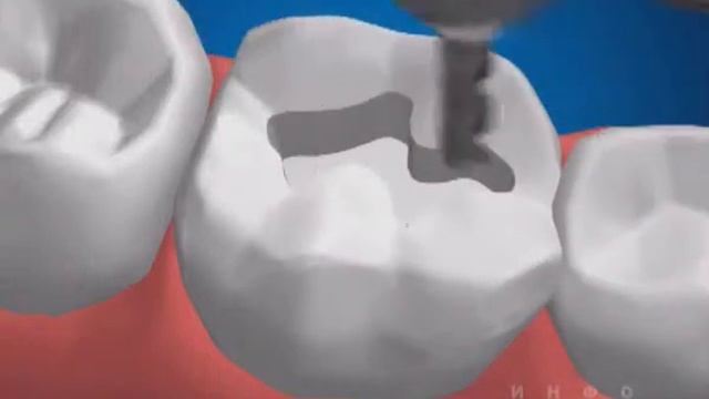 Кариозная полость 1 класса смотреть онлайн