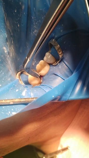 Щипцы для секционных матриц. Sowdan. Аналог Polidentia. смотреть онлайн