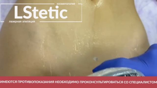 Эпиляция на модели