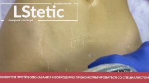 Эпиляция на модели