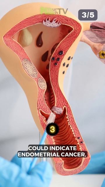 5 Signs Of Cancer Mostly Ignored By WOMEN смотреть онлайн