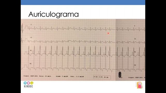 Electrofisiología Auriculograma смотреть онлайн