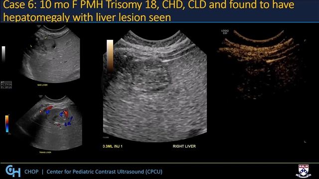 Intravenous Contrast Ultrasound Applications in Children смотреть онлайн