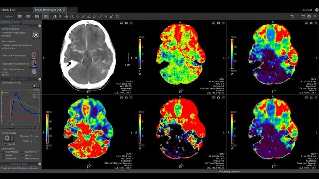 Vitrea Demonstrations  |  2D Brain Perfusion