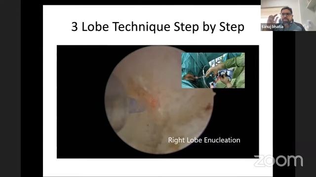 Laser Enucleation of Prostate : Simplified смотреть онлайн