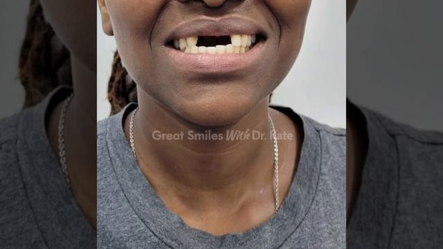 Tooth Loss Cases We've Treated - Dentures, Dental Bridges and Dental Implants in Nairobi, Kenya смотреть онлайн