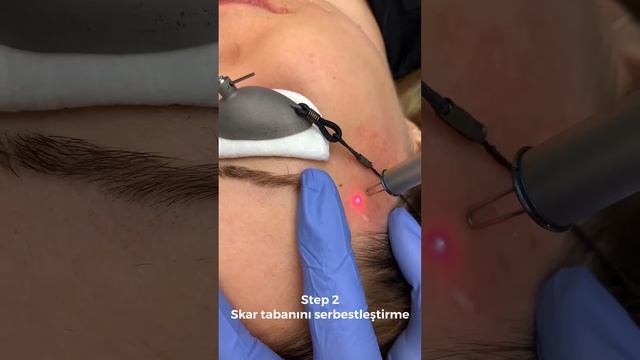 Akne İzleri Tedavisi @dr.eminsoyer смотреть онлайн