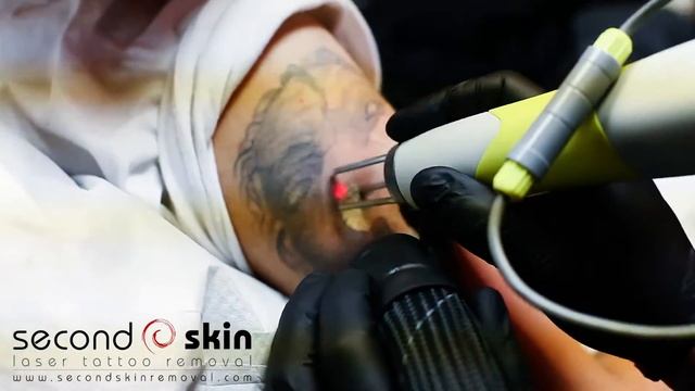 Second Skin Tattoo Removal - How much does it hurt? смотреть онлайн