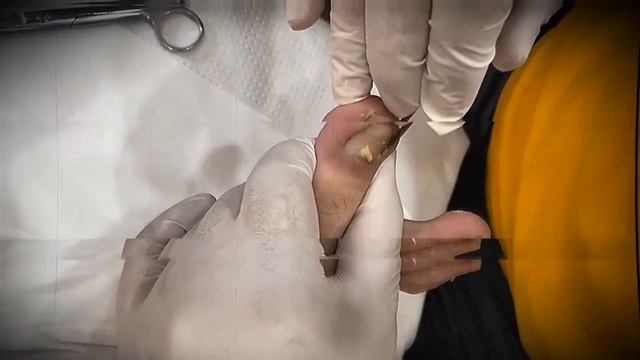 Ingrown Toenail - The Best Clip Clean Toenail At Shop And Home # 34