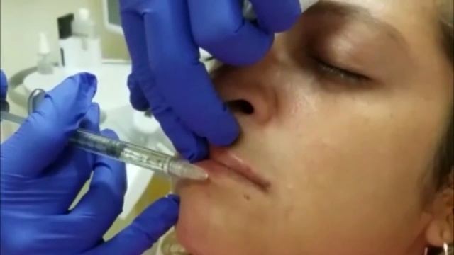 Lip Augmentation with Juvederm Ultra XC смотреть онлайн