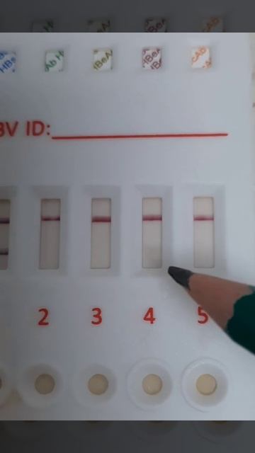 HBV (hepatitis B virus) test shows positive reaction for (HBs Ag and HB core). смотреть онлайн
