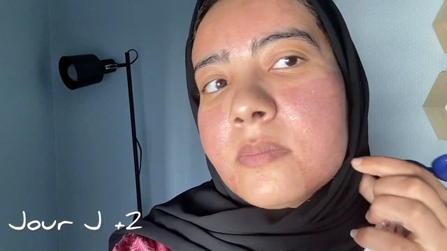 Mon expérience avec Laser CO2 fractionné(review 8 days)/تجربتي مع تقنية لازير لإزالة آثار حب الشباب смотреть онлайн