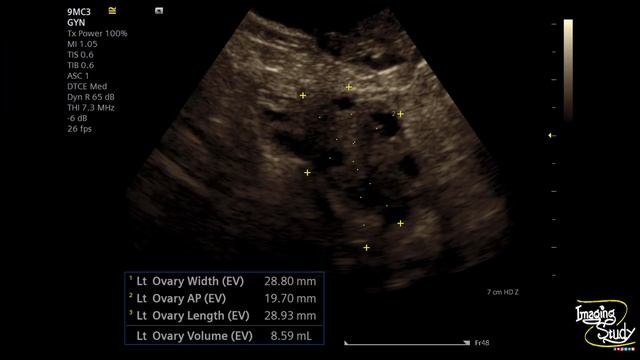 Polycystic Ovarian Disease with Nabothian Cysts || PCOD || Ultrasound || TVS || Case 256 смотреть онлайн