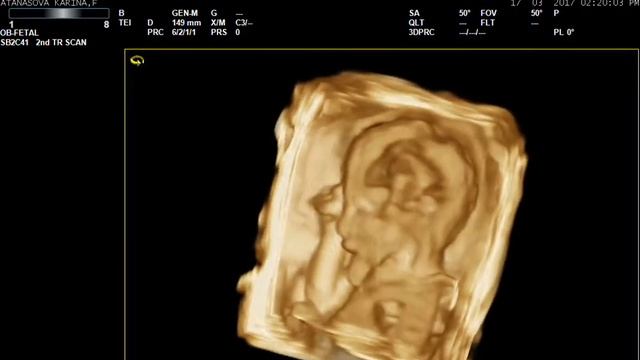 Фетална морфология / 4D 19г.с +4 смотреть онлайн