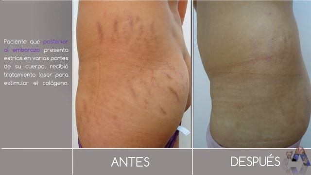 Tratamientos para todo tipo de ESTRIAS de embarazo, aumento de peso, crecimiento fotos antes despue смотреть онлайн
