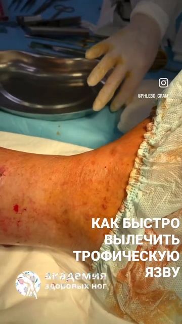 Заплаточку поставили Самая лучшая повязка-это закрыть трофическую язву собственной кожей 8499375455 смотреть онлайн