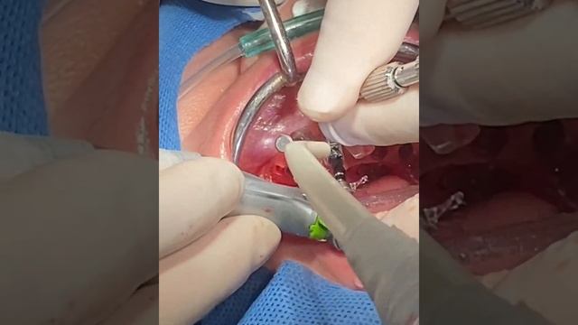 all on 6 with Nobel guide смотреть онлайн