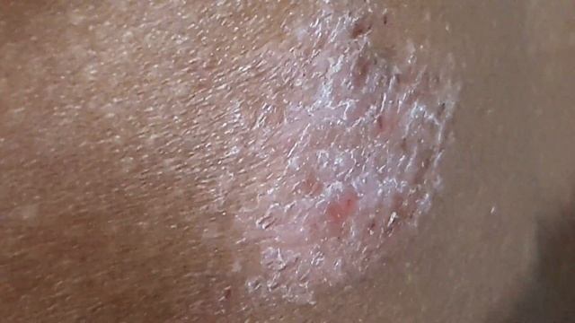 Tinea Manuum смотреть онлайн
