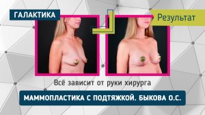 Маммопластика с подтяжкой - результат |  Быкова Оксана Сергеевна